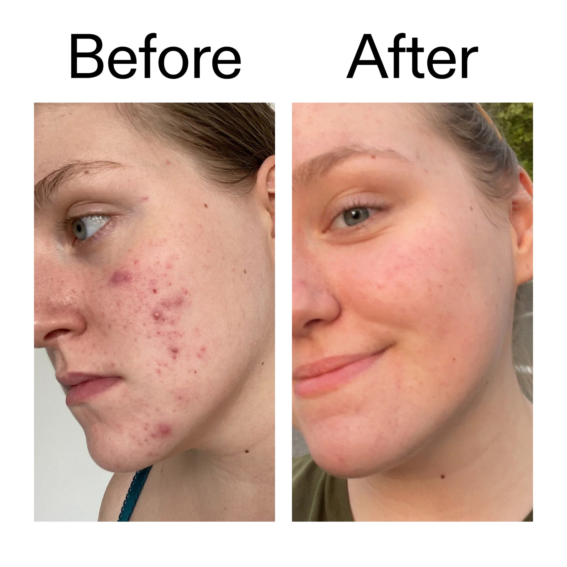 15-vitamin-c-egf-serum-p5 15_Vitamin_C_EGF_Serum_Before_After_2000x2000_fb9f598a-3386-40c8-8143-36f9d7a17ec8.jpg