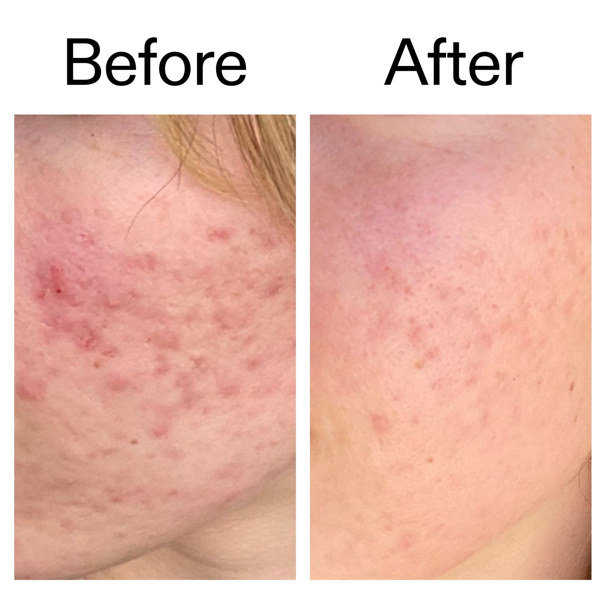 10-azelaic-acid-serum-for-redness-relief-k3 Azealic_Acid_Serum_B_A_Ppage_2000_x_2000.jpg