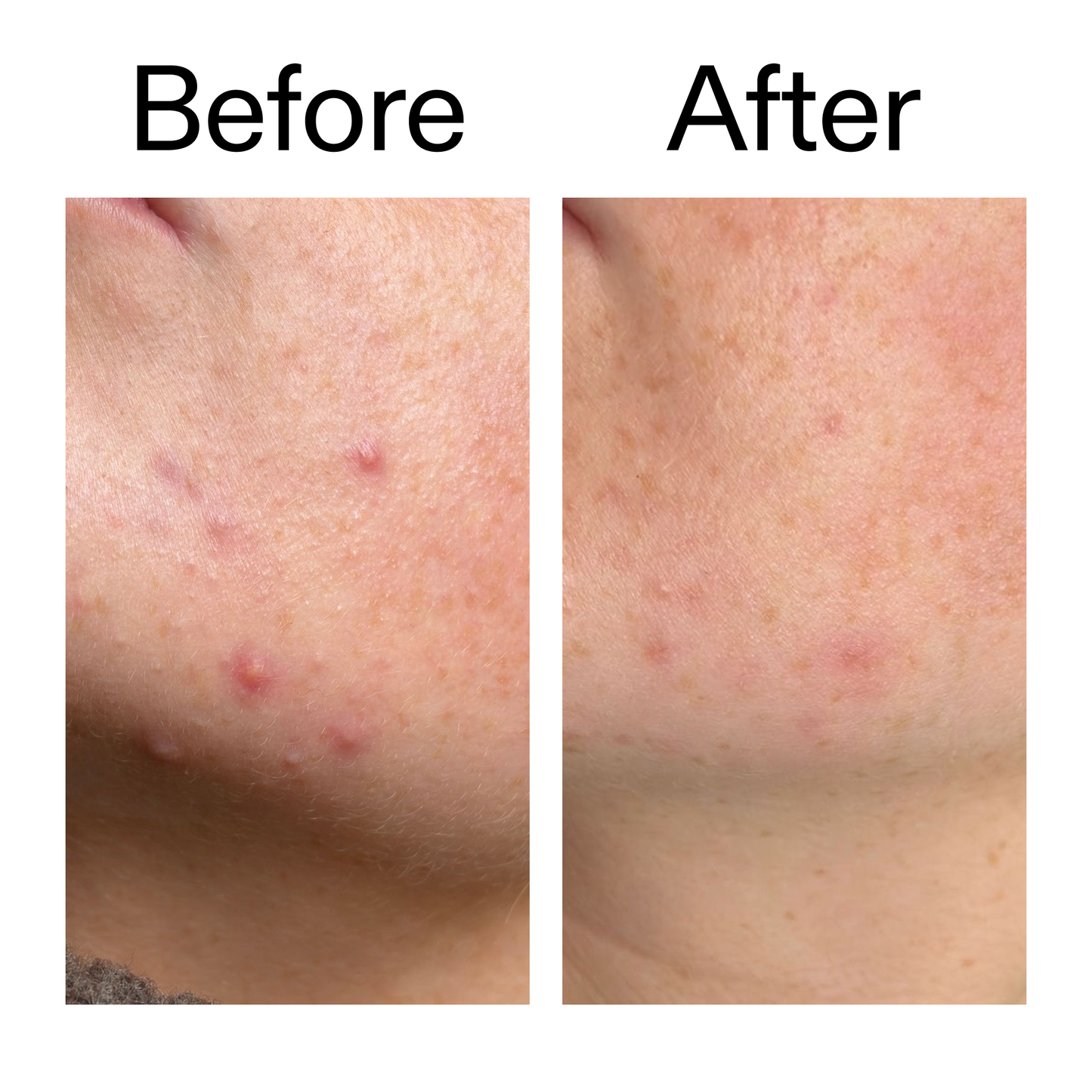 10-azelaic-acid-serum-for-redness-relief-k3 B_A_1_PPAGE.png