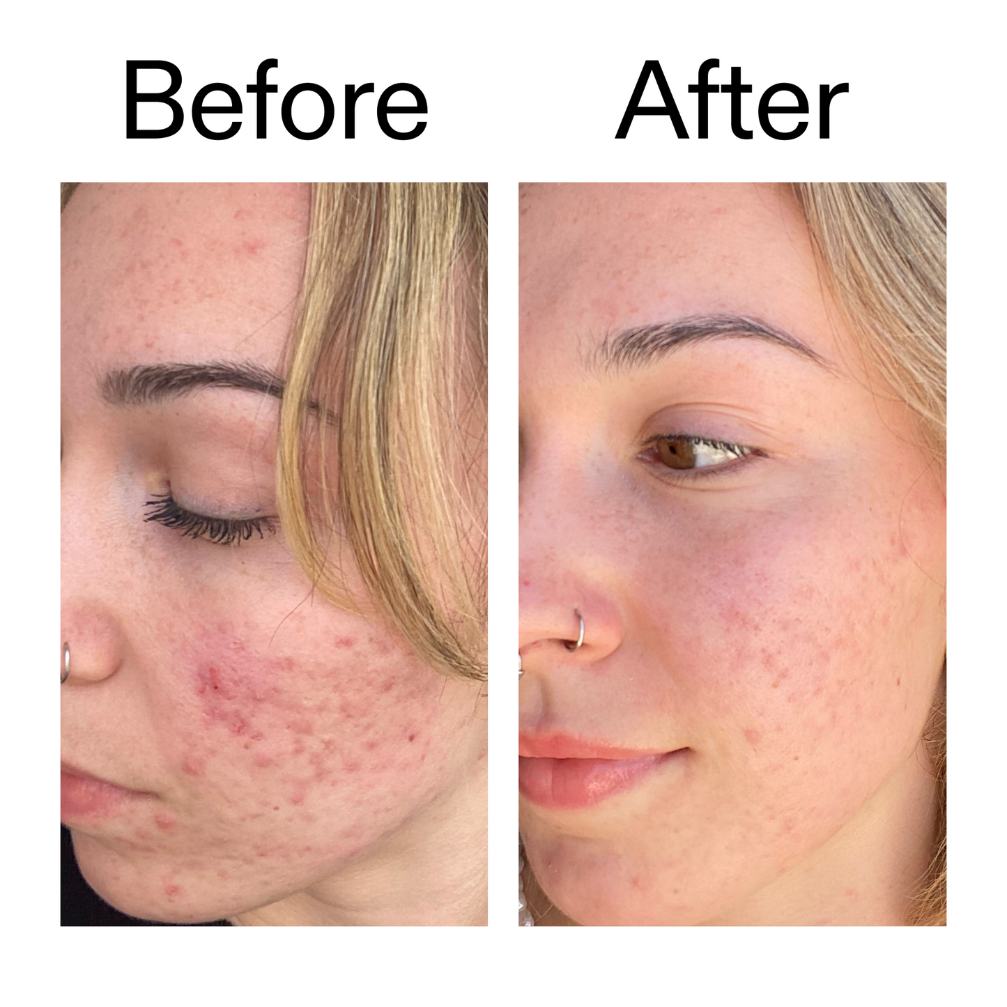 10-azelaic-acid-serum-for-redness-relief-k3 B_A_2_PPAGE.png