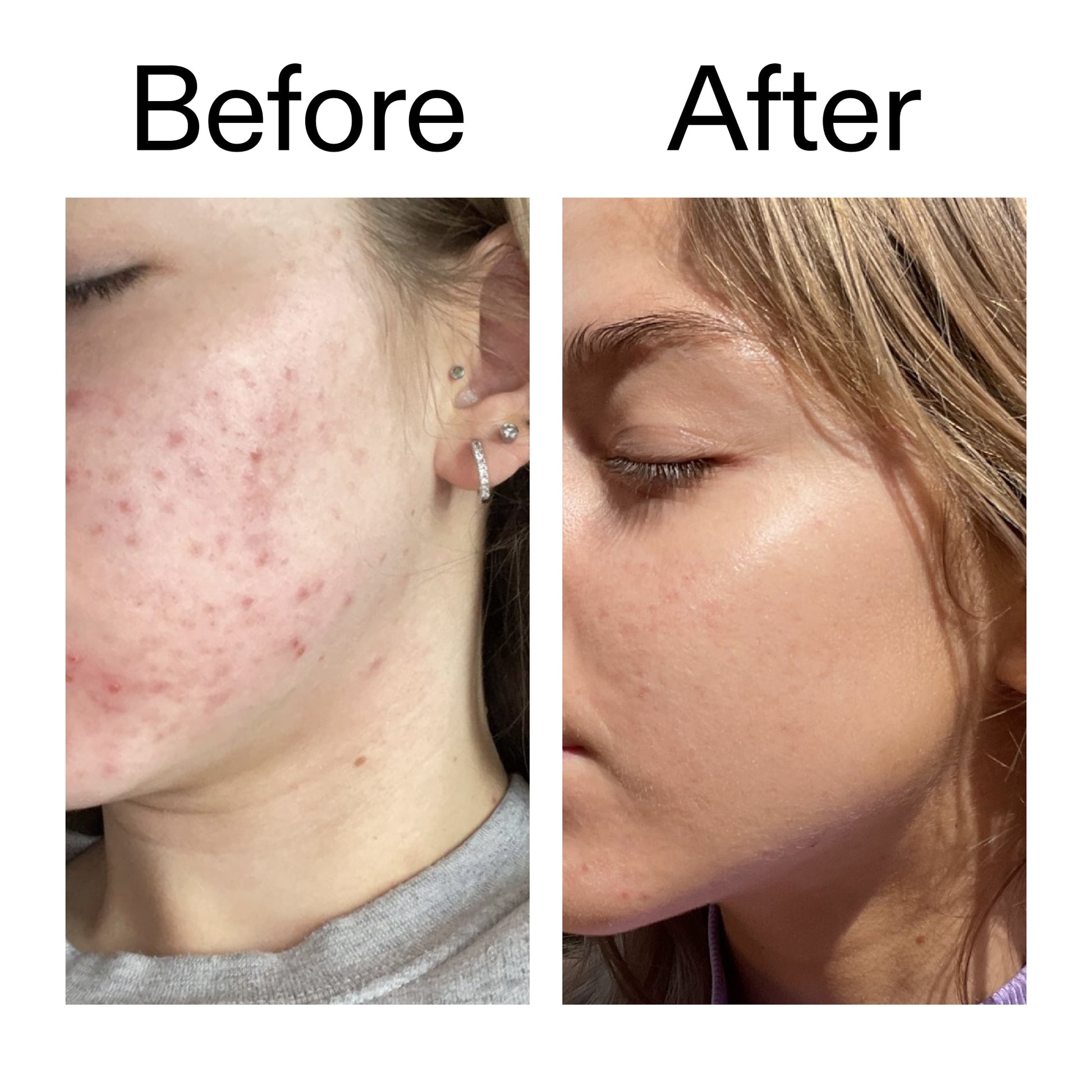 beta-hydroxy-acid-bha-serum-s4 Beta_Hydroxy_Acid_Serum_Before_After_2000x2000_96fda3e5-938d-49ef-bcf2-a0fa6ece4e2c.jpg