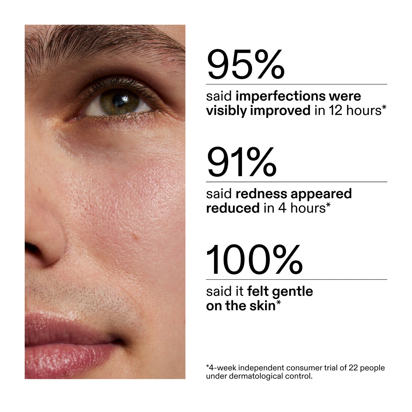 succinic-acid-acne-treatment-l0 CA_Succinic_Acid_Treatment_key_Claims_2000x2000_db91b0f1-7f29-4bfe-bb16-63a47f500960.jpg