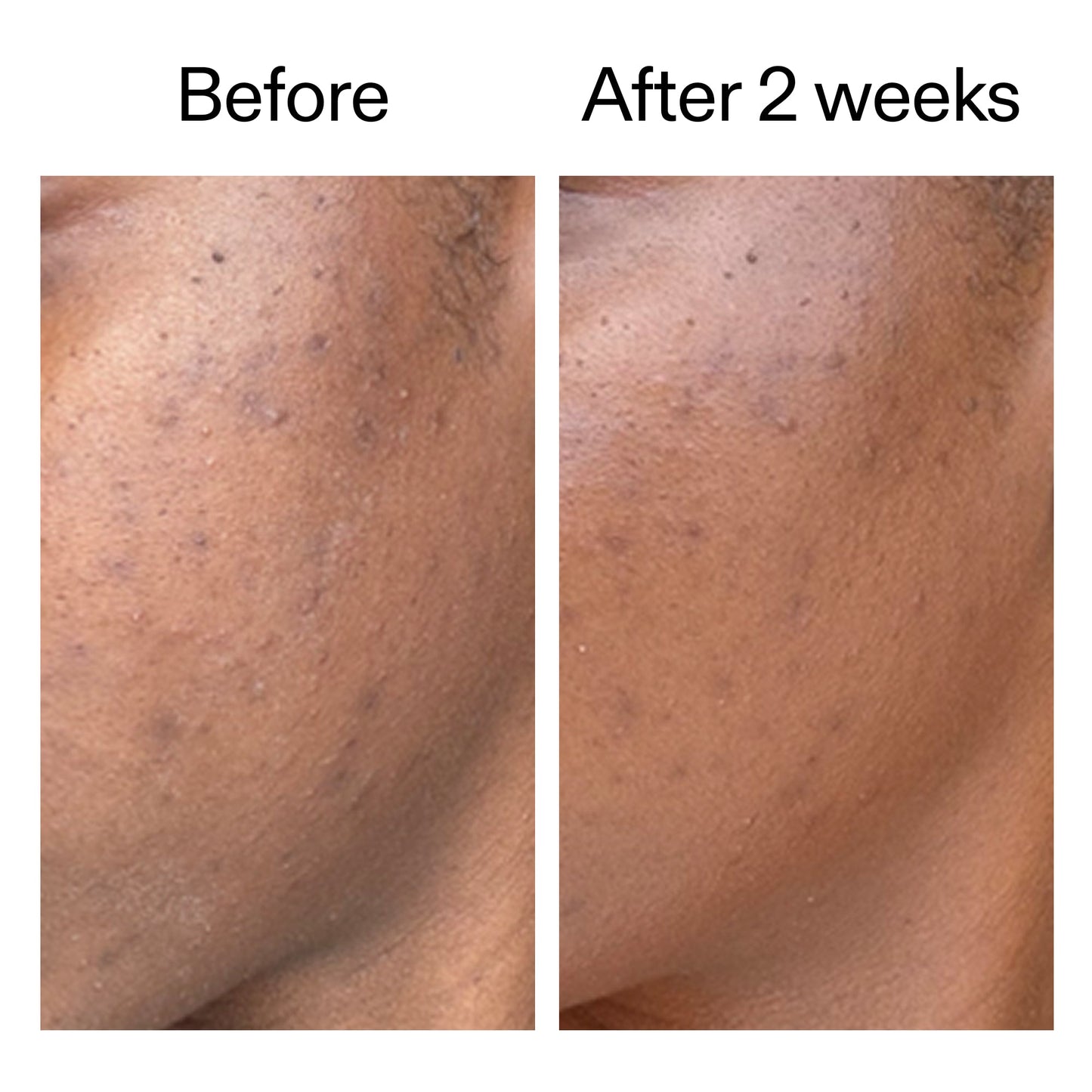 360-acne-clearing-serum-p4 DIOICB_A2000x2000.jpg