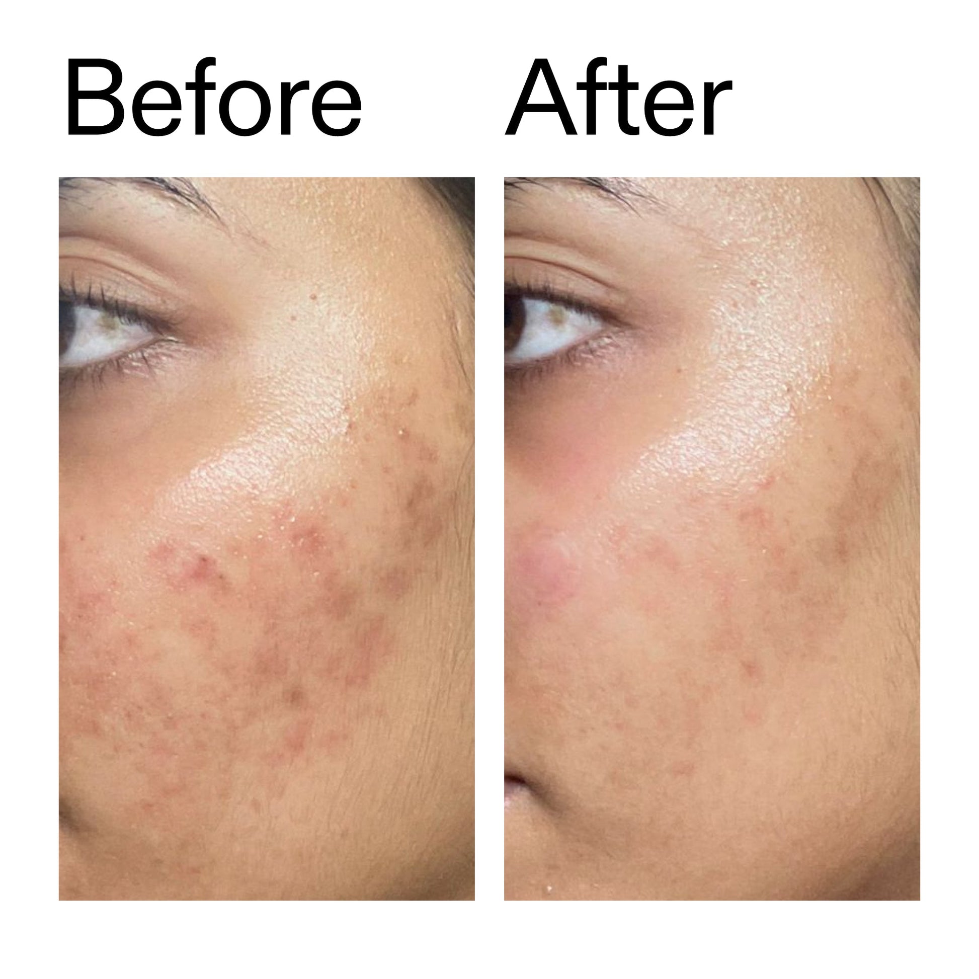 ectoin-hydro-barrier-serum-duo-k6 Ectoin_Hydro-barrier_Serum__Before_After_2000x2000_34261920-d004-48d0-9c7b-8e1c15971bfd.jpg