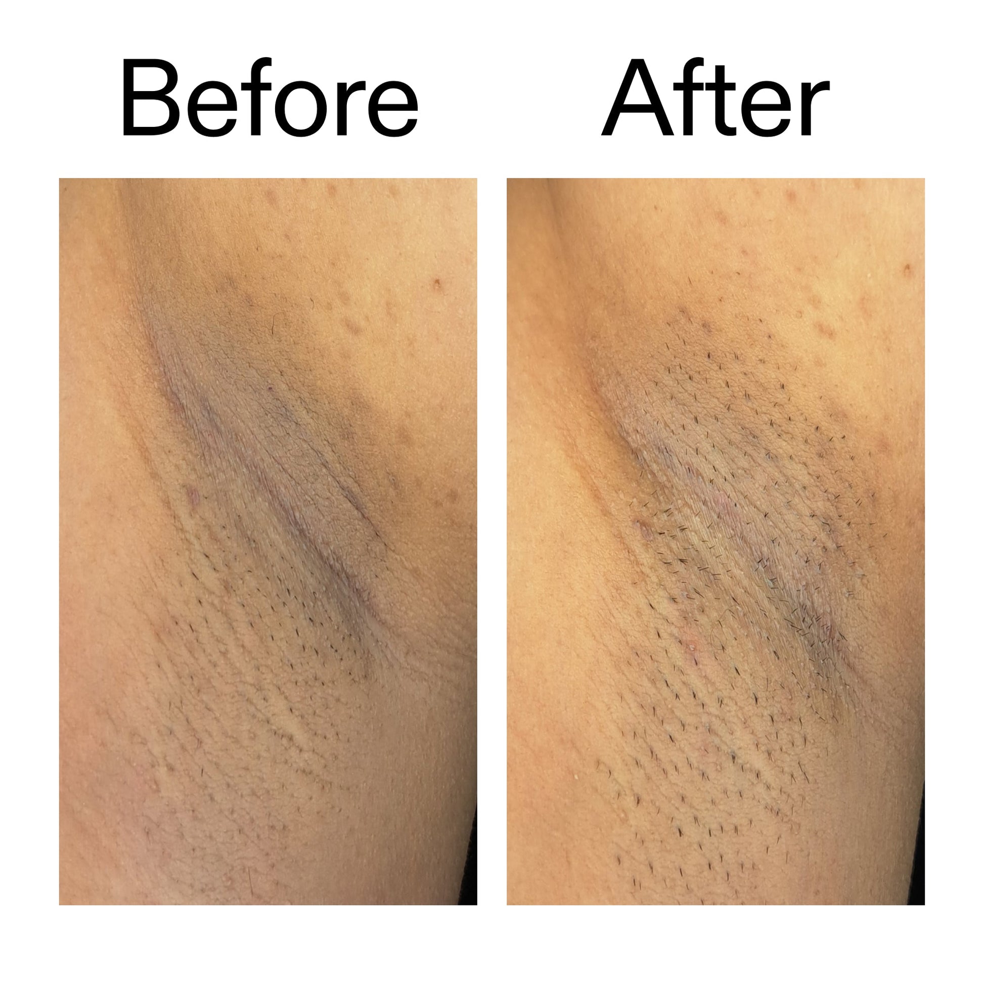 glycolic-acid-exfoliating-body-stick-d3 Glycolic_Acid_Exfoliating_Body_Stick_Before_After_V3_2000x2000_ea919cd9-1439-4a46-82a0-76200eb5bb42.jpg