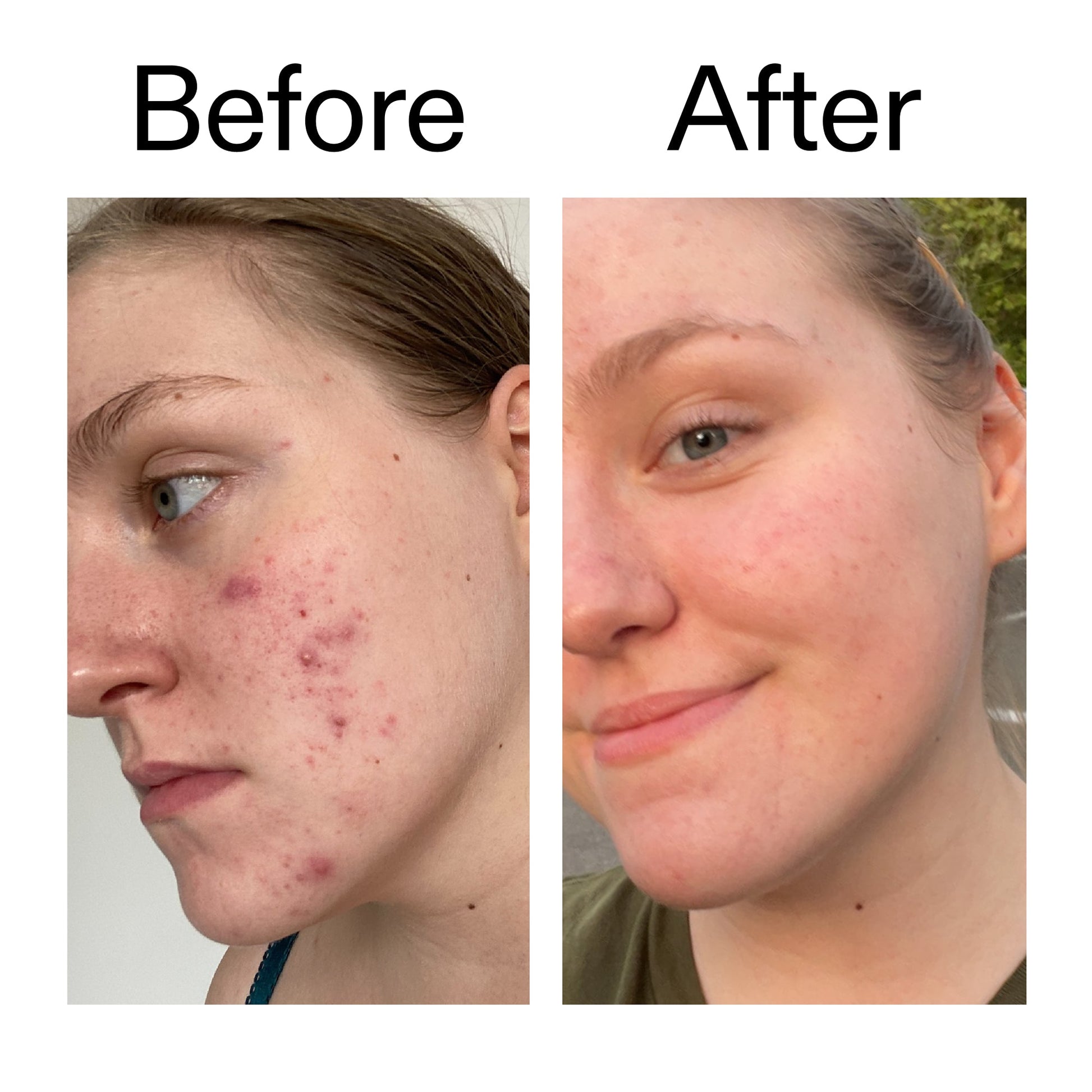 glycolic-acid-toner-o6 Glycolic_Acid_Toner_Before_After_2000x2000_49f0b9f7-e71b-4b2e-a8f8-2ea4b73247bb.jpg