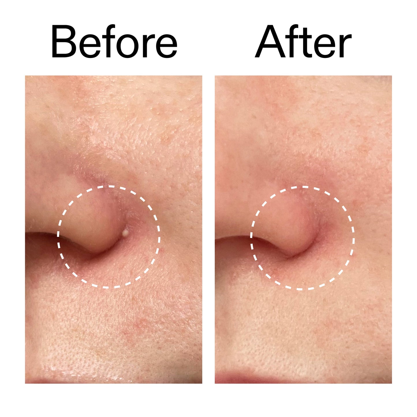 hydrocolloid-invisible-pimple-patches-pack-of-44-k5 Hydrocolloid_Invisible_Pimple_Patches_Before_After_2000x2000_b02aa37b-c78a-4682-91de-9135af5bb7df.jpg