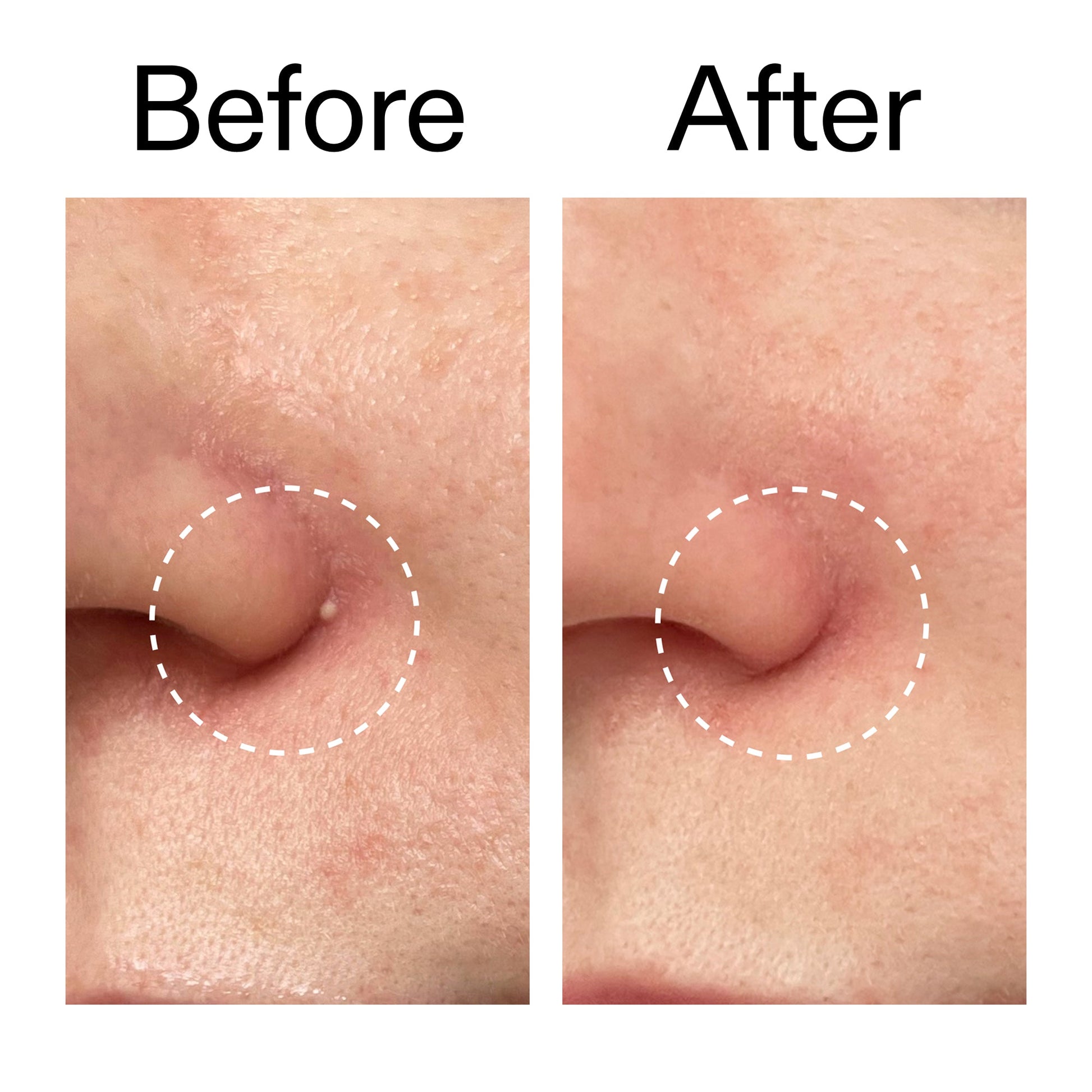 hydrocolloid-invisible-pimple-patches-pack-of-22-f6 Hydrocolloid_Invisible_Pimple_Patches_Before_After_2000x2000_b02aa37b-c78a-4682-91de-9135af5bb7df.jpg