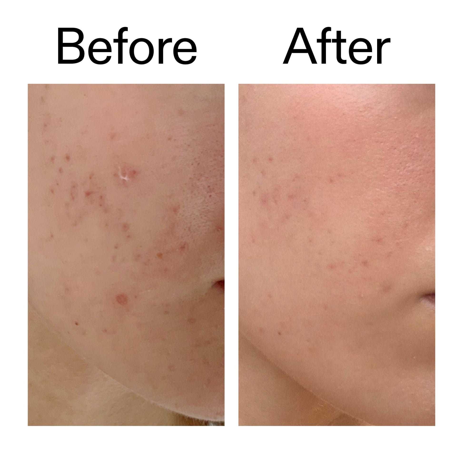 mandelic-acid-treatment-m7 Mandelic_Acid_Treatment_Before_After_2000x2000_4885ac6e-c5d7-4279-a72a-1417af7dce35.jpg