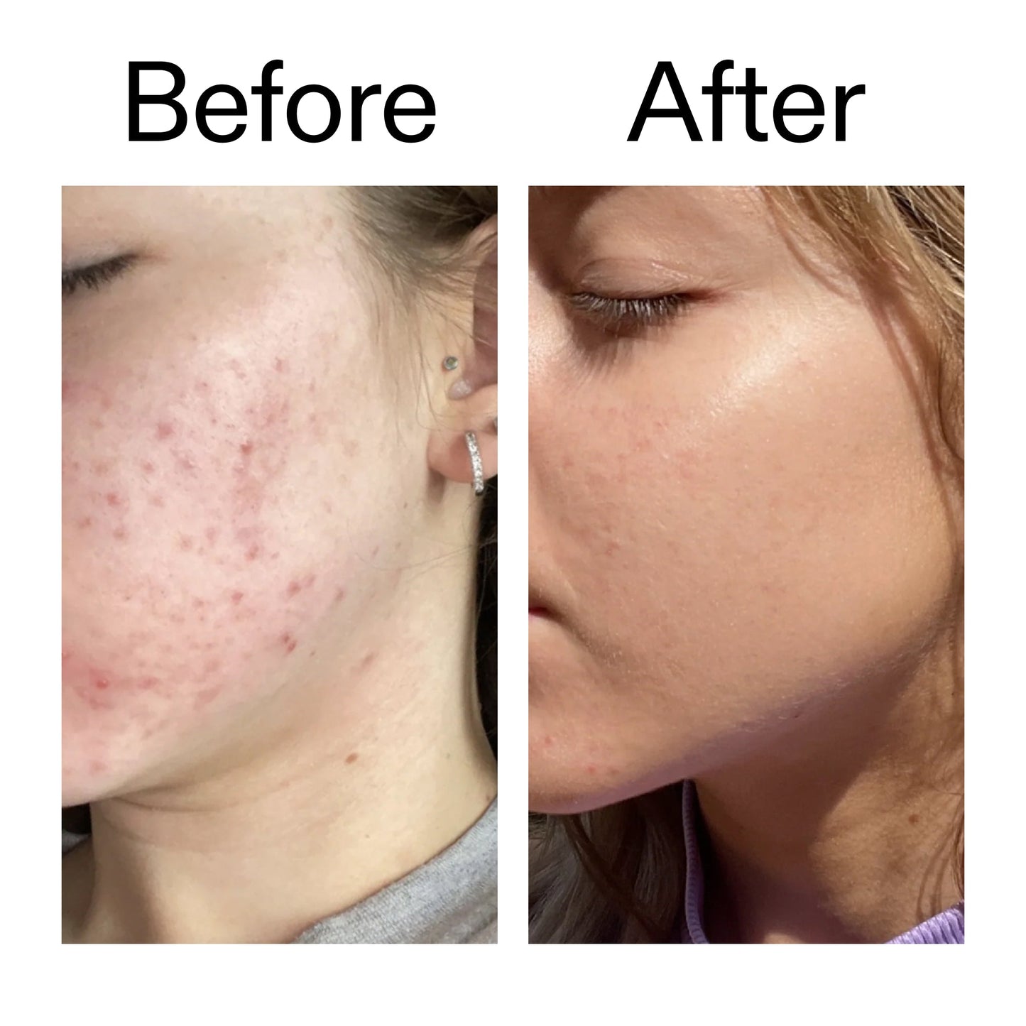 10-niacinamide-serum-duo-a9 Niacinamide_Serum_Before_After_2000x2000_bde32455-9e7d-448e-b053-bef41504f0a9.jpg
