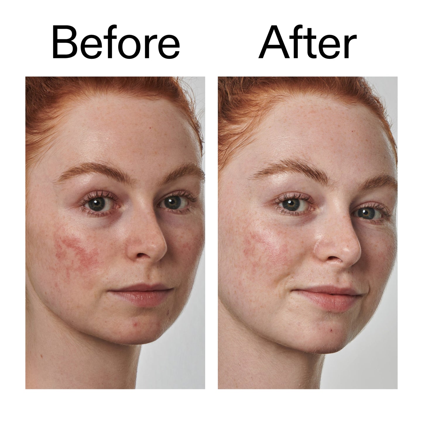 10-azelaic-acid-serum-for-redness-relief-k3 Redness_Relief_Serum_Before_After_2000x2000_3334dc9a-cce9-4e00-8aec-7ad89ca051f2.jpg