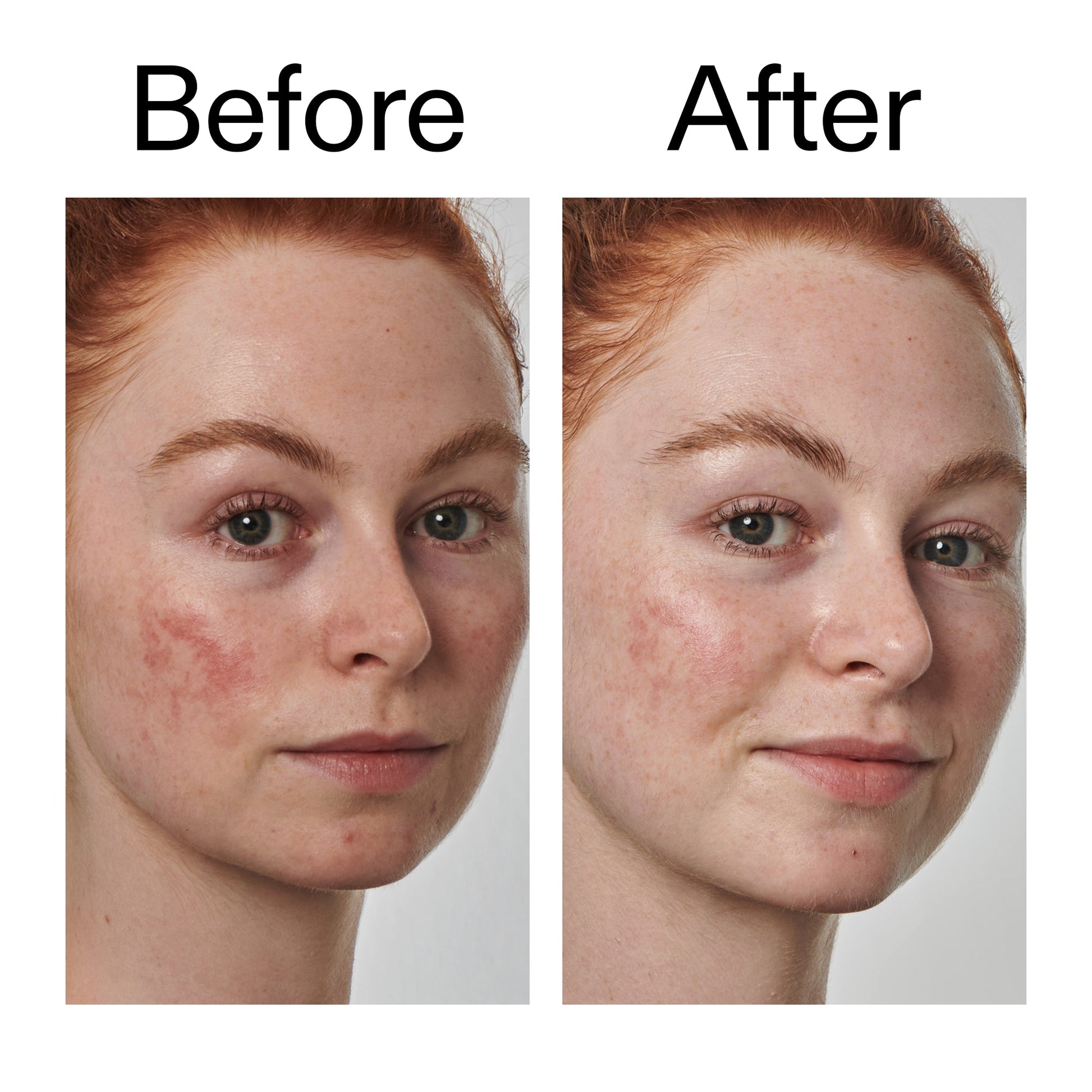 10-azelaic-acid-serum-for-redness-relief-k3 Redness_Relief_Serum_Before_After_2000x2000_3334dc9a-cce9-4e00-8aec-7ad89ca051f2.jpg
