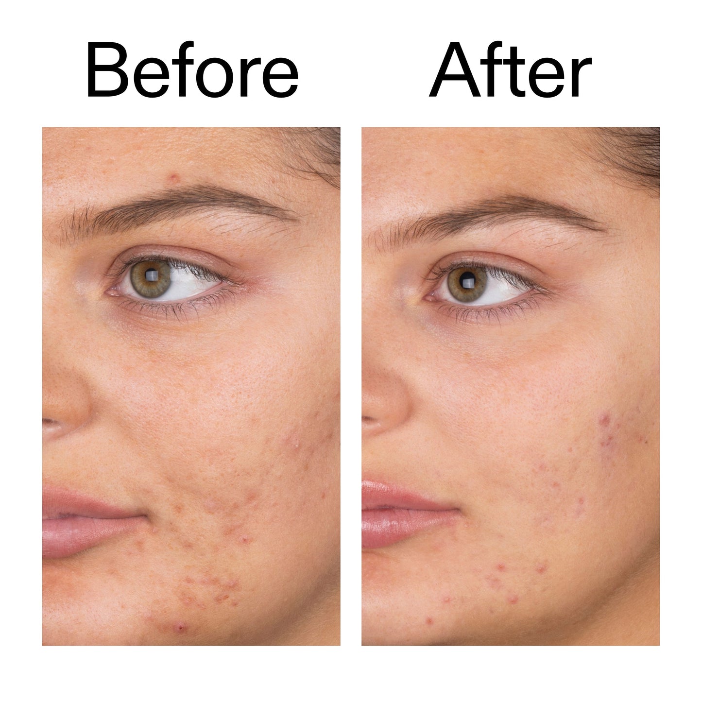 salicylic-acid-cleanser-150ml-w3 Salicylic_Acid_Cleanser_-_150ml_Before_After_2000x2000_e7230494-853f-4b07-82b1-27669104c995.jpg