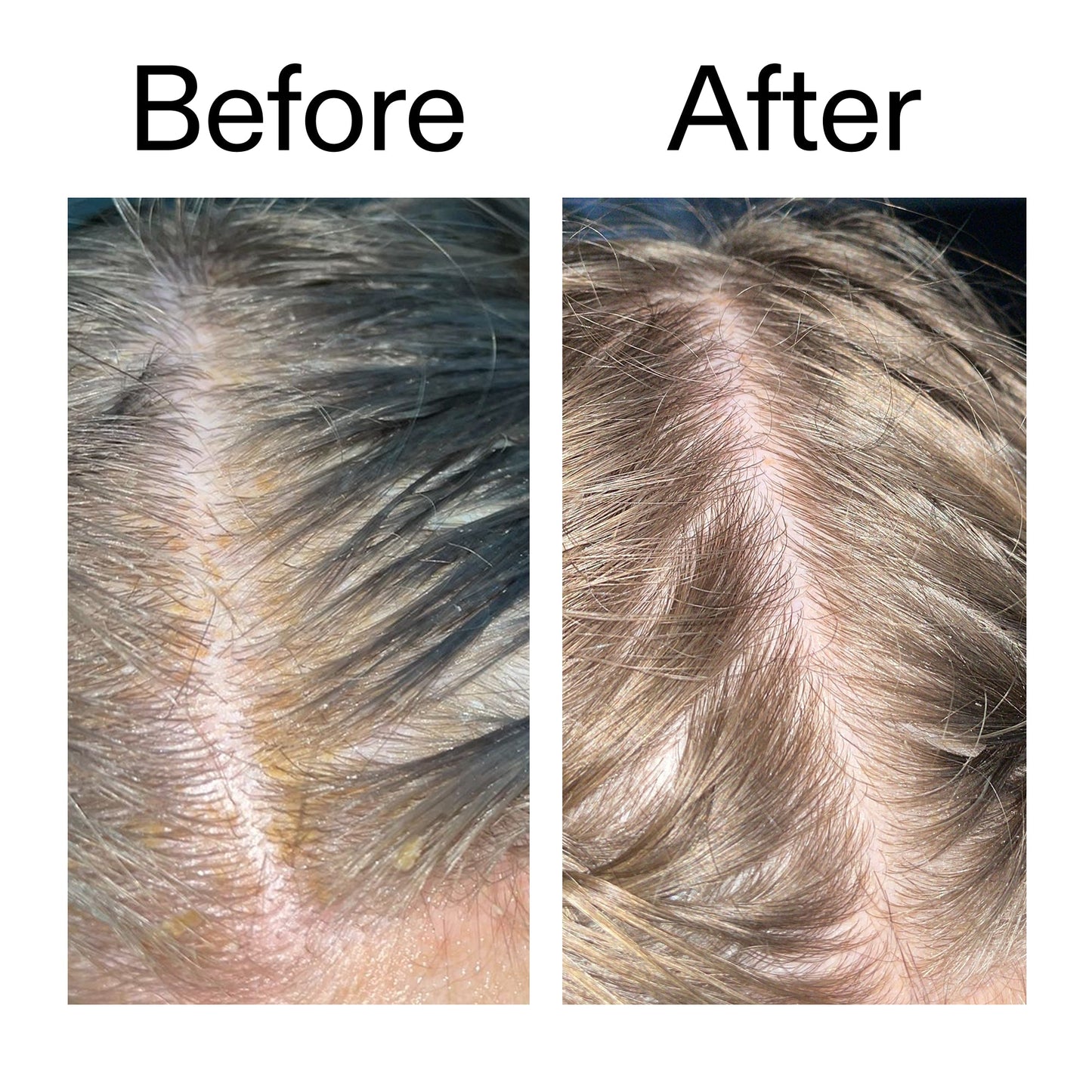 salicylic-acid-exfoliating-scalp-treatment-n7 Salicylic_Acid_Exfoliating_Scalp_Treatment_Before_After_2000x2000_e572a30f-057c-4a48-823b-1c09dc97f8d0.jpg