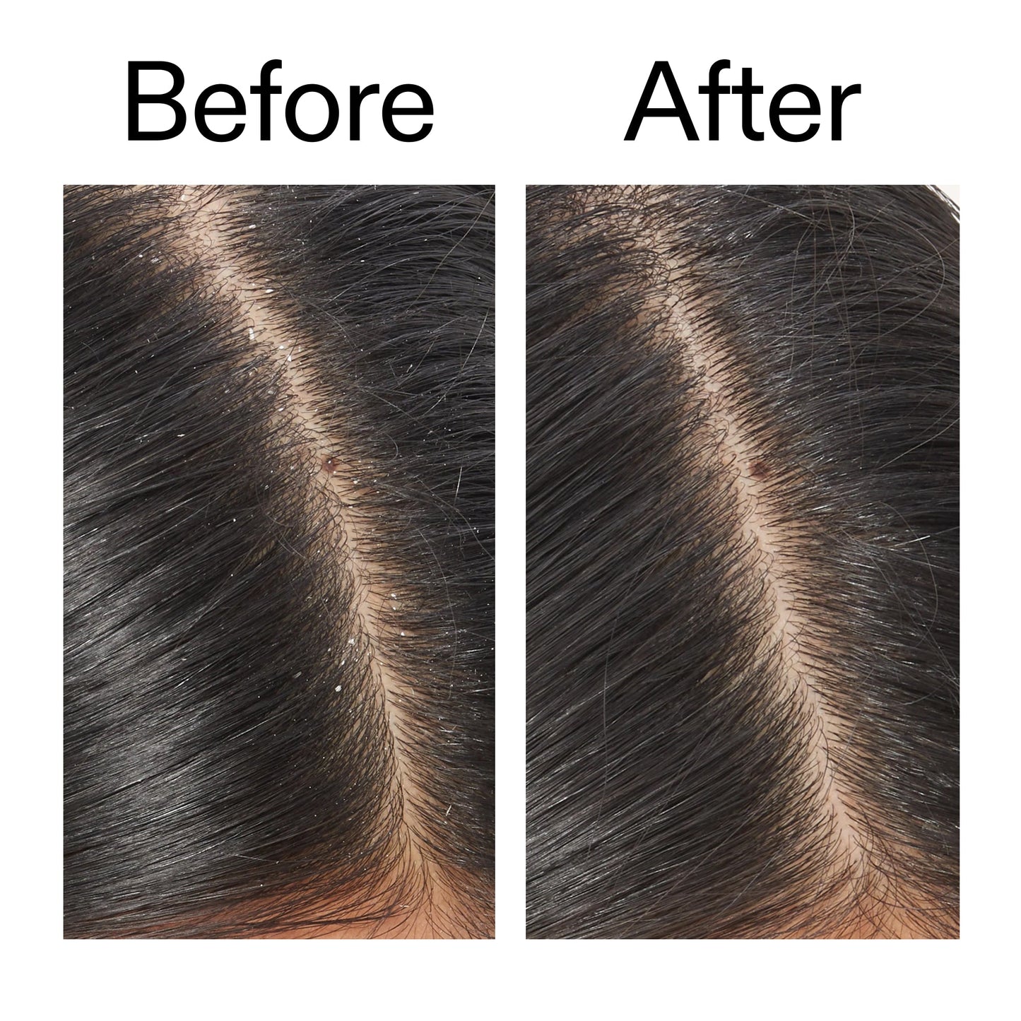 salicylic-acid-exfoliating-scalp-treatment-n7 Salicylic_Acid_Exfoliating_Scalp_Treatment_Before_After_V2_2000x2000_02bd61ad-42bf-490b-b3e3-7e04b2e8a673.jpg