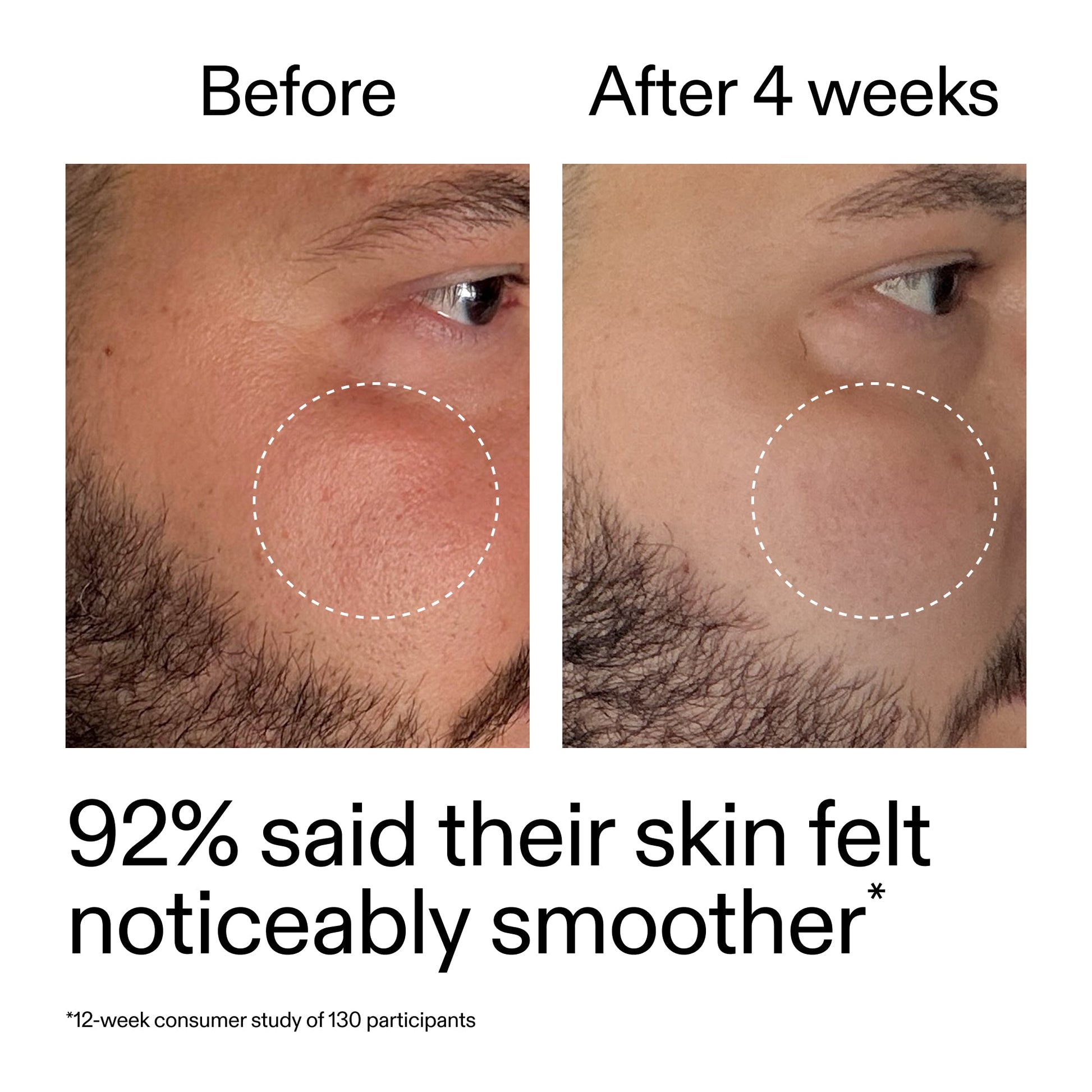 starter-retinol-serum-duo-s0 StarterRetinol_BeforeAfter_Claim3_2000x2000_458243a8-bbb0-4e5d-a274-29c7766d339b.jpg