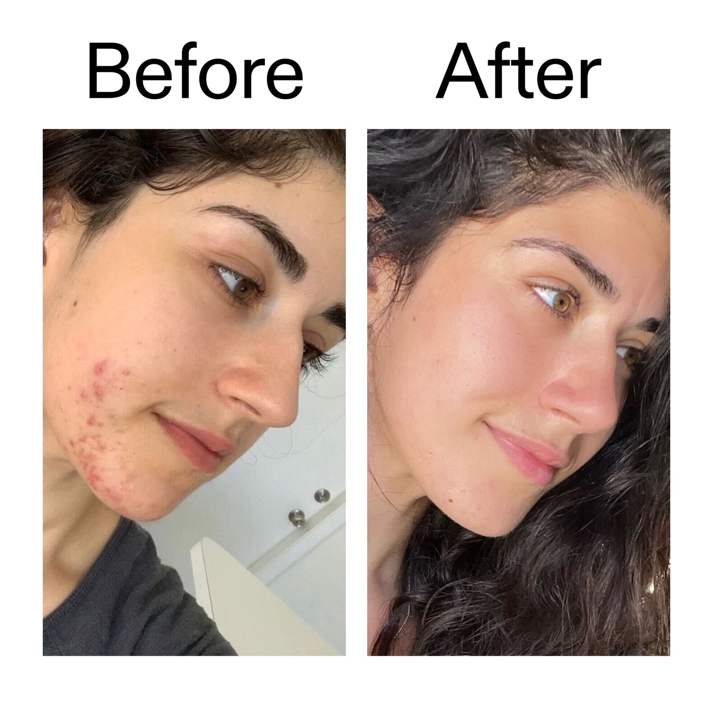 succinic-acid-acne-treatment-l0 Succinic_Acid_Treatment_Before_After_2000x2000_6a5f0054-2f58-4433-9314-0dc72c9bdd3b.jpg