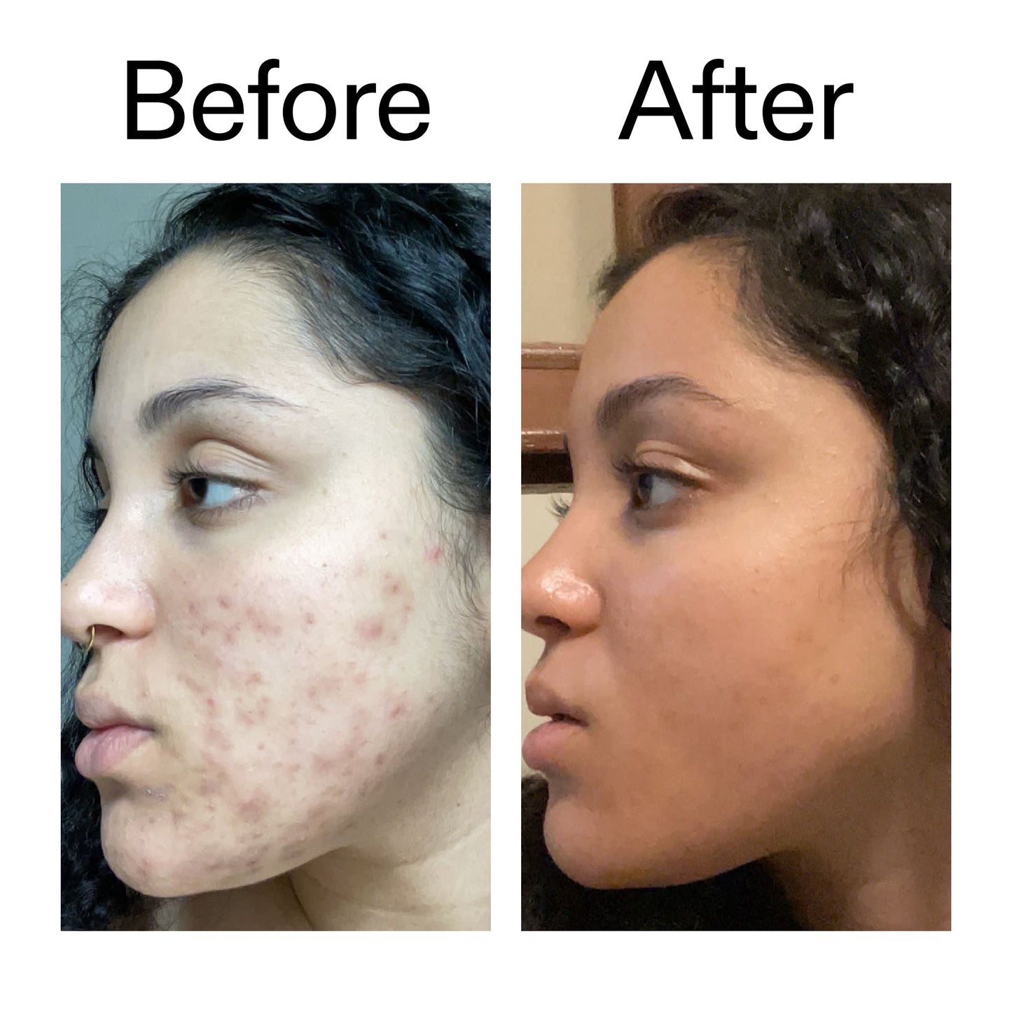 tranexamic-acid-serum-r1 Tranexamic_Acid_Serum_Before_After_2000x2000_98ebc8be-77b0-4843-8a22-90790ebe918b.jpg